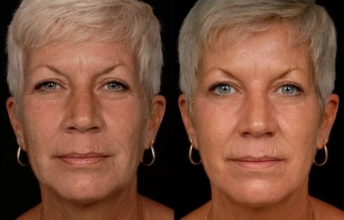 Yüz derisinin lazer tedavisinin sonucu - kırışıklıkların azalması